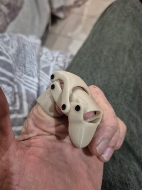 S.P. wearing the beige prosthetic, close view showing fit on the index finger